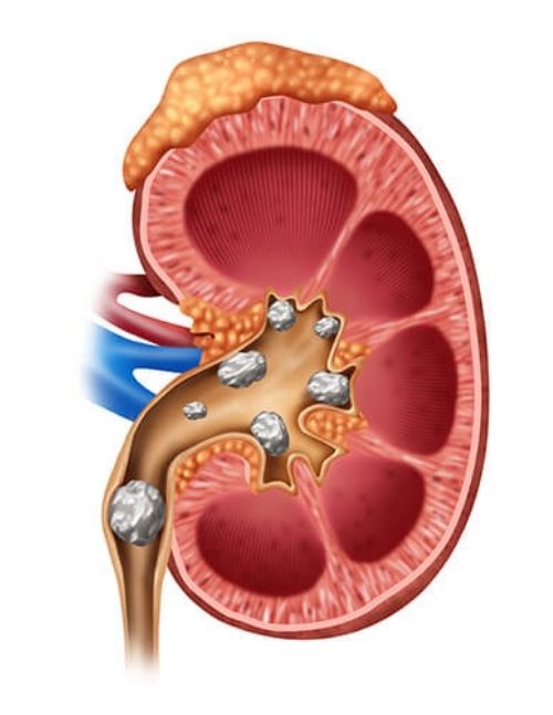 Ayurvedic treatment for urinary tract and kidney disorders