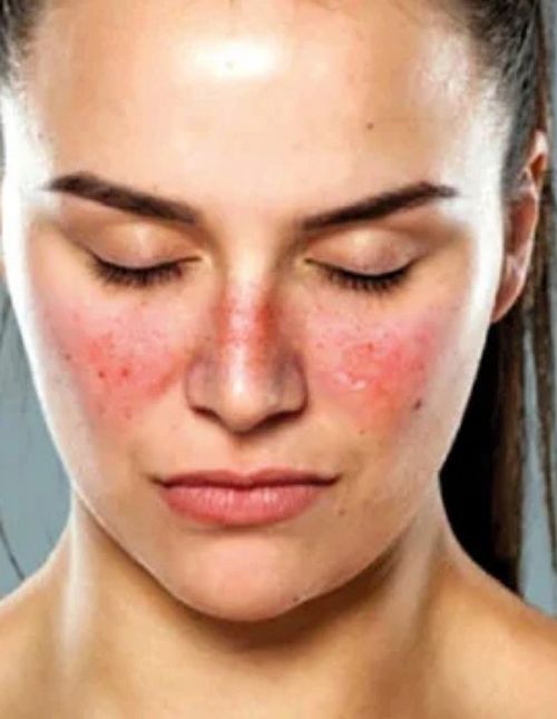 Ayurvedic Treatment for Systemic Lupus Erythematosus in Lucknow