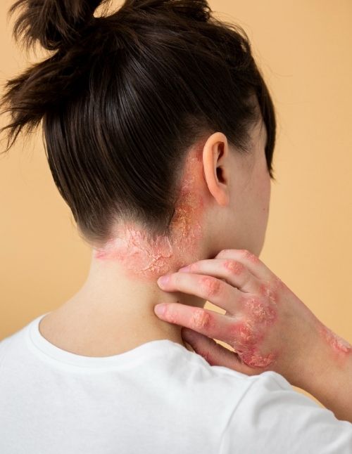 Ayurvedic Treatment for Systemic Lupus Erythematosus in Lucknow